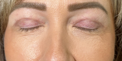 Eyelid Lift Before & After Patient #4756