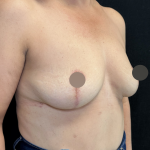 Breast Lift Before & After Patient #4758