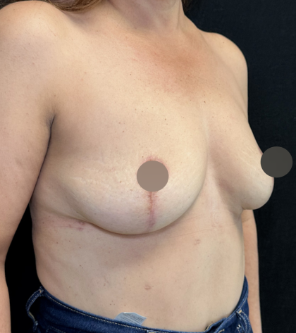 Breast Lift Before & After Patient #4758