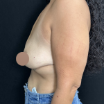 Breast Lift Before & After Patient #4752