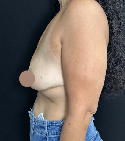Breast Lift Before & After Patient #4752