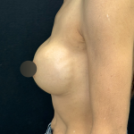 Breast Lift Before & After Patient #4757
