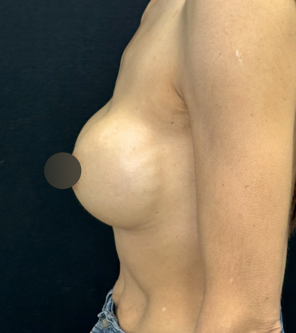 Breast Lift Before & After Patient #4757