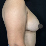 Breast Lift Before & After Patient #4758