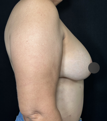 Breast Lift Before & After Patient #4758
