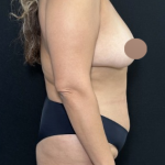 Breast Lift Before & After Patient #4759