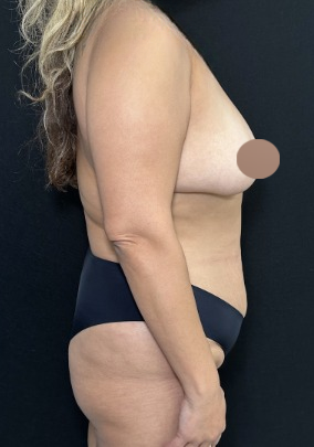 Breast Lift Before & After Patient #4759