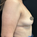 Breast Lift Before & After Patient #4758