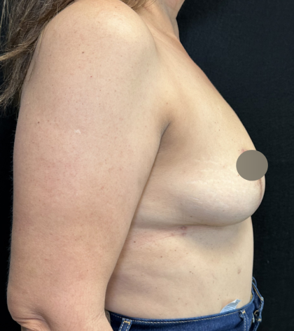Breast Lift Before & After Patient #4758