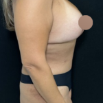 Breast Lift Before & After Patient #4759