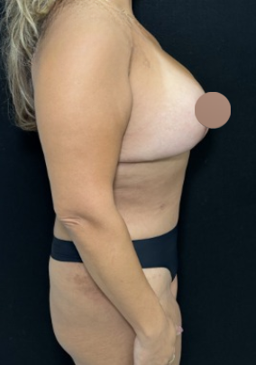 Breast Lift Before & After Patient #4759