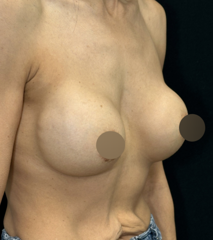 Breast Lift Before & After Patient #4757
