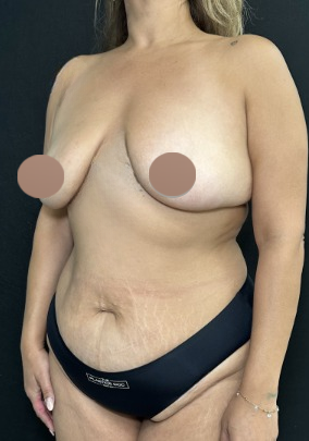 Breast Lift Before & After Patient #4759