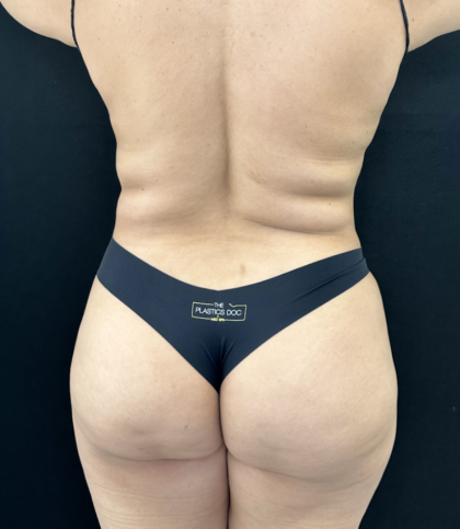 Liposuction Before & After Patient #4760