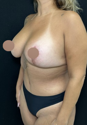 Breast Lift Before & After Patient #4759