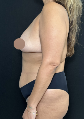 Breast Lift Before & After Patient #4759