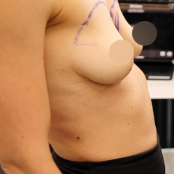 alloClae Before & After Patient #4668