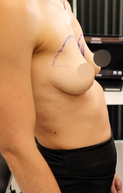 alloClae Before & After Patient #4668