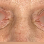 Eyelid Lift Before & After Patient #4748