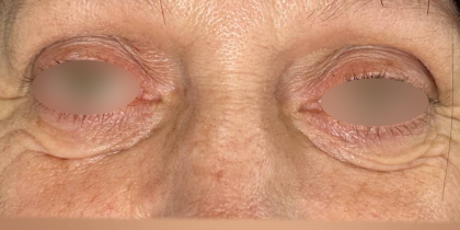 Eyelid Lift Before & After Patient #4748