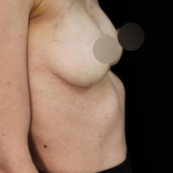 alloClae Before & After Patient #4668