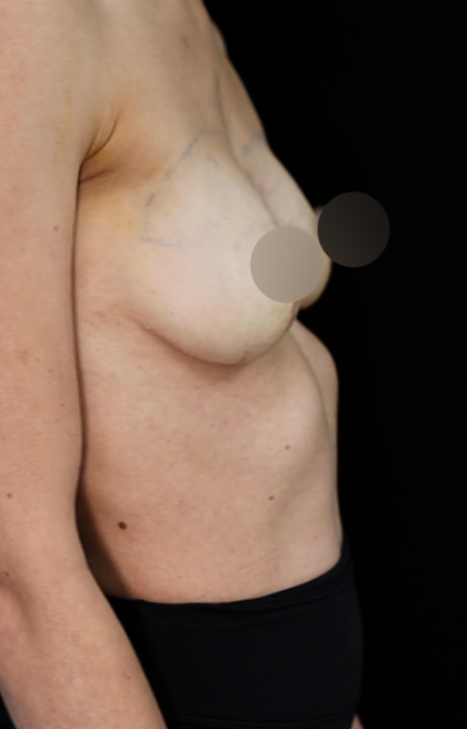 alloClae Before & After Patient #4668