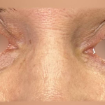 Eyelid Lift Before & After Patient #4748
