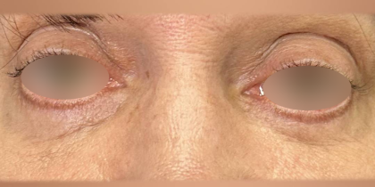 Eyelid Lift Before & After Patient #4748