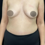 alloClae Before & After Patient #5085