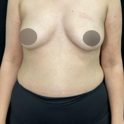 alloClae Before & After Patient #5085