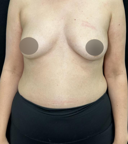 alloClae Before & After Patient #5085