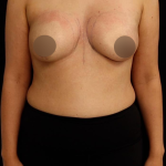 alloClae Before & After Patient #5085
