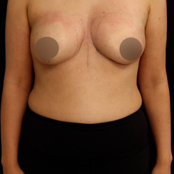 alloClae Before & After Patient #5085