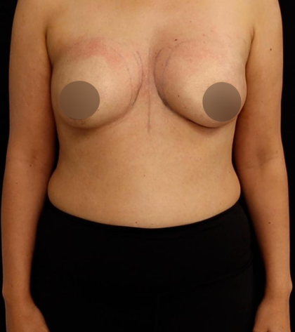 alloClae Before & After Patient #5085