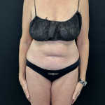 Tummy Tuck Before & After Patient #5082