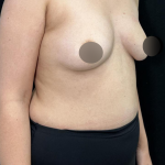alloClae Before & After Patient #5085