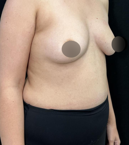 alloClae Before & After Patient #5085