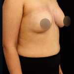 alloClae Before & After Patient #5085