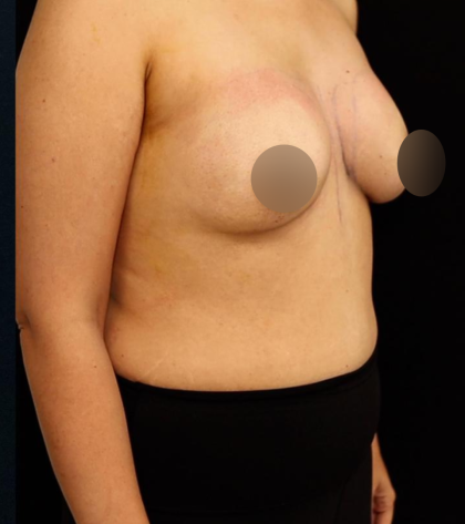 alloClae Before & After Patient #5085