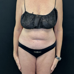 Tummy Tuck Before & After Patient #5082