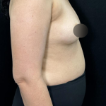 alloClae Before & After Patient #5085