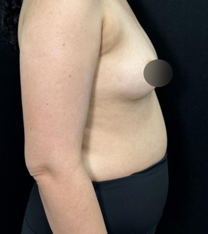 alloClae Before & After Patient #5085