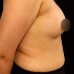 alloClae Before & After Patient #5085