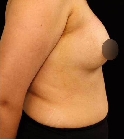 alloClae Before & After Patient #5085