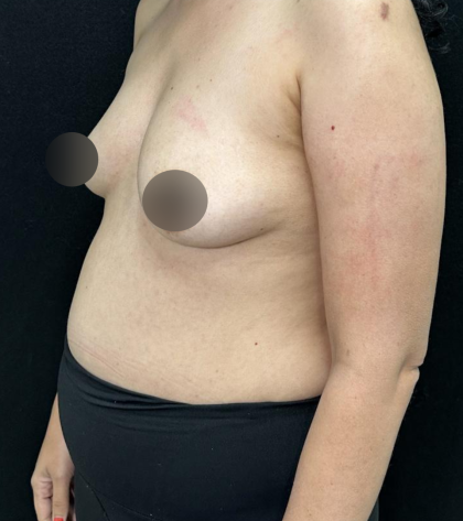 alloClae Before & After Patient #5085