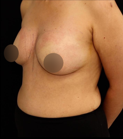 alloClae Before & After Patient #5085