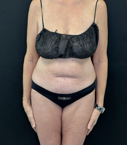 Tummy Tuck Before & After Patient #5082