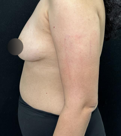 alloClae Before & After Patient #5085