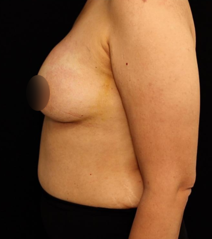 alloClae Before & After Patient #5085