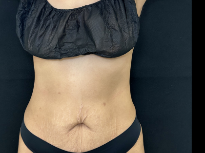 Tummy Tuck Before & After Patient #5144